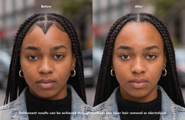 get rid of widow's peak